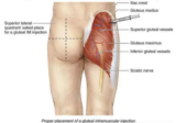 What causes PIP? Post Injection Pain
